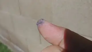 Healing Process of my Sliced Thumb Slideshow