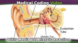 Otitis Media Acute vs. Otitis Media Allergic &mdash; Medical Coding Tips