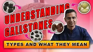 Understanding Gallstones: Types and What They Mean