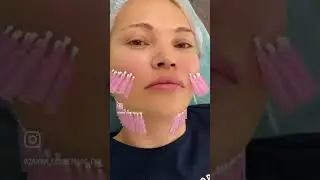 Тредлифтинг мононити лифтинг