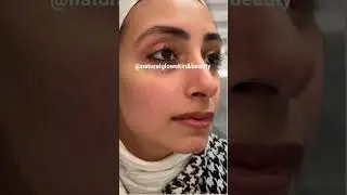 bye to acne scars #acnefreeskin #scarfree #clearskin #reels #trending #skintreatment #facialcare