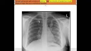 Salter Harris fracture with revision of previous cases