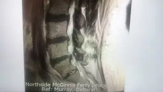 Disc resorption in the lumbar spine