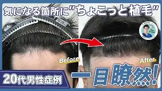 一目瞭然！ 気になる箇所にちょこっと植毛