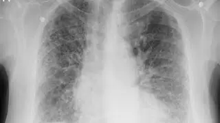 Dr Mursi || PACES CLUB || Lung Fibrosis - Station One Respiratory