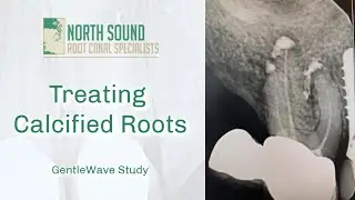 Root Canal Treatment on a Calcified Tooth- GentleWave&reg;