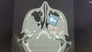 Septal Bony Spur Present in CT Images, Which Can Cause Contact Headache #BonyNasalSeptalSpur