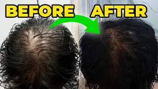 Why I switched from finasteride to dutasteride | 1 Year Later