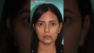Immediate Eyelid Rejuvenation | Blepharoplasty Before & After