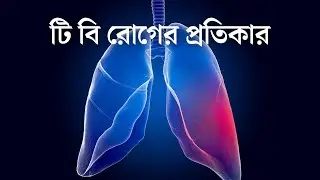 টি বি রোগের প্রতিকার । Remedy for TB disease । STOPTB