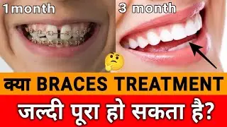 क्या Braces Treatment जल्दी पूरा हो सकता है | Can Braces Treatment be completed quickly |