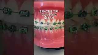 Braces Tie Falls Off? Here&rsquo;s What To Do&hellip; 🦷 #shorts