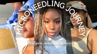 Microneedling Journey for Acne Scars, Dark Marks| SkinPen Treatment Results, Before and After