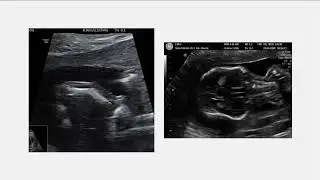 Fetal Anomalies: Skeletal