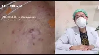 LASER HELIOS, LASER FLEK, MELASMA, GLOW LASER, REJUVENATION