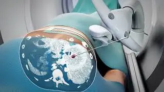 Revolutionizing Medical Procedures: The MR-Guided Needle Placement Robot