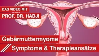 Myome: Prof. Dr. Hadji &uuml;ber moderne Therapien