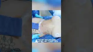 Full Body Glow-Up: 360 Lipo, BBL, Tummy Tuck & Breast Revision!