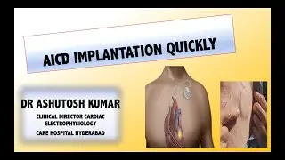 Automatic Implantable Cardioverter Defibrillator (AICD) Implantation-How it is implanted ?