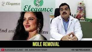Mole Removal, Face Makeover Treatment Surat, Vadodara, Ahmedabad, Gujarat, Mumbai