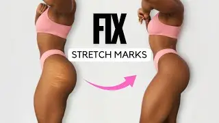 FIX STRETCH MARKS NATURALLY &ndash; At-Home Routine! 