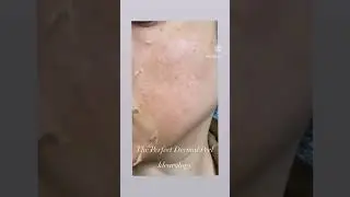 The Perfect Dermal Peel 💙🤩 #inlandempire #peel #beauty #skincarejunkie #skinpeel