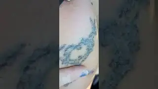 Healing process for Neatcell Blue Light Laser Tattoo Removal