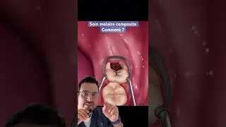 SOIN composite sur une carie de molaire : COMMENT proc&eacute;der ? 🤔