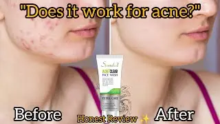 Sandal Acne Clear Face Wash &ndash; Real Results or Just Hype?