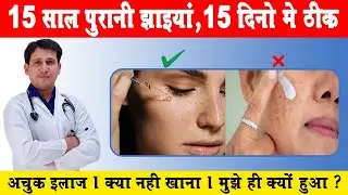 melasma | melasma treatment | pigmentation on face | ayurvedic treatment pigmentation |