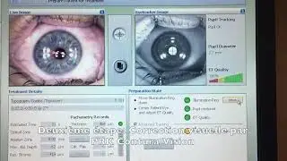 Trans PRK Topoguided Contoura Vision (technique no touch 100% laser)