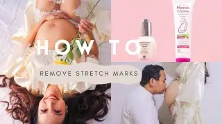 My recommended routine to remove stretch marks | Mama&rsquo;s Choice Stretch Mark Treatment series