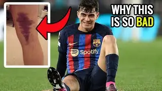 Pedri Hamstring Injury - Permanent Hamstring Problem Pedri Could Face After This - Doctor Explains