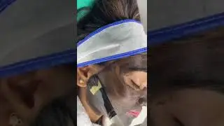 Carbon Facial Treatment | Laser Facial | Carbon Peel treatment