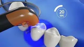 COLTENE - BRILLIANT Bulk Fill Flow - Step by Step - By Qualumpur