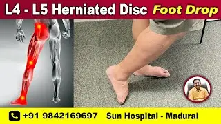 L4-L5 Herniated Disc SCIATICA Foot Drop NUMBNESS cured without surgery  | Sun Hospital Madurai.