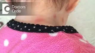 Does swelling & redness point toward spider bite? - Dr. Nischal K