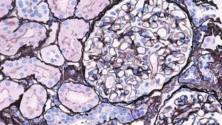 Minimal Change Disease - Pathology mini tutorial
