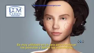Breast Implants Tijuana Mexico | Dr. Daniel Camacho-Melo | Brazilian Butt Lift Tijuana Mexico