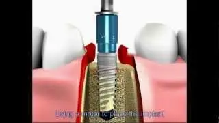 Dr Farrah Maghsoudy, DMD-La Jolla,Ca- Dental implant procedure