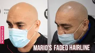 Mario&rsquo;s Faded Hairline done using  Scalp Micropigmentation