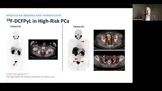 PSMA-Targeted PET Imaging & Radioligand Therapy in the Management of Prostate Cancer
