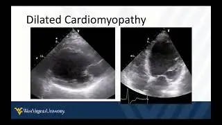 Cardiopulmonary POCUS 7 - Left Ventricular Failure