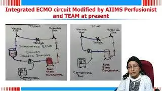 Low Flow ECMO Management in Post Cardiac Patients by Ritu Airan
