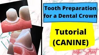 Crown Preparation - Maxillary Canine