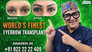 World&rsquo;s Finest Eyebrow Transplant | Natural & Permanent Results by Anagen Mumbai