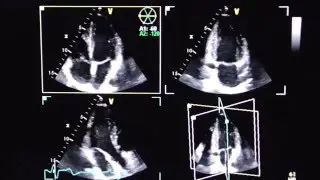 Triplane Echokardiographie (triplane echocardiography)
