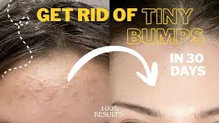 How to Get rid of tiny BUMPs quickly | 100% results