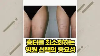 지방흡입 흉터 | 영상으로 보는 블로그 | 닥터 조의 지방흡입에 대한 생각들