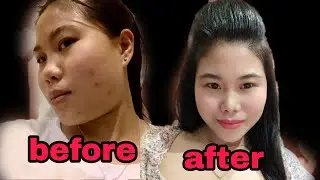 effective scars removal cream100%🥰/newGel+E silicon Gel scar removal &whitening